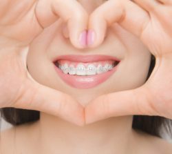 Dental braces in happy womans mouths through the heart. Brackets on the teeth after whitening. Self-ligating brackets with metal ties and gray elastics or rubber bands for perfect smile. Orthodontic teeth treatment